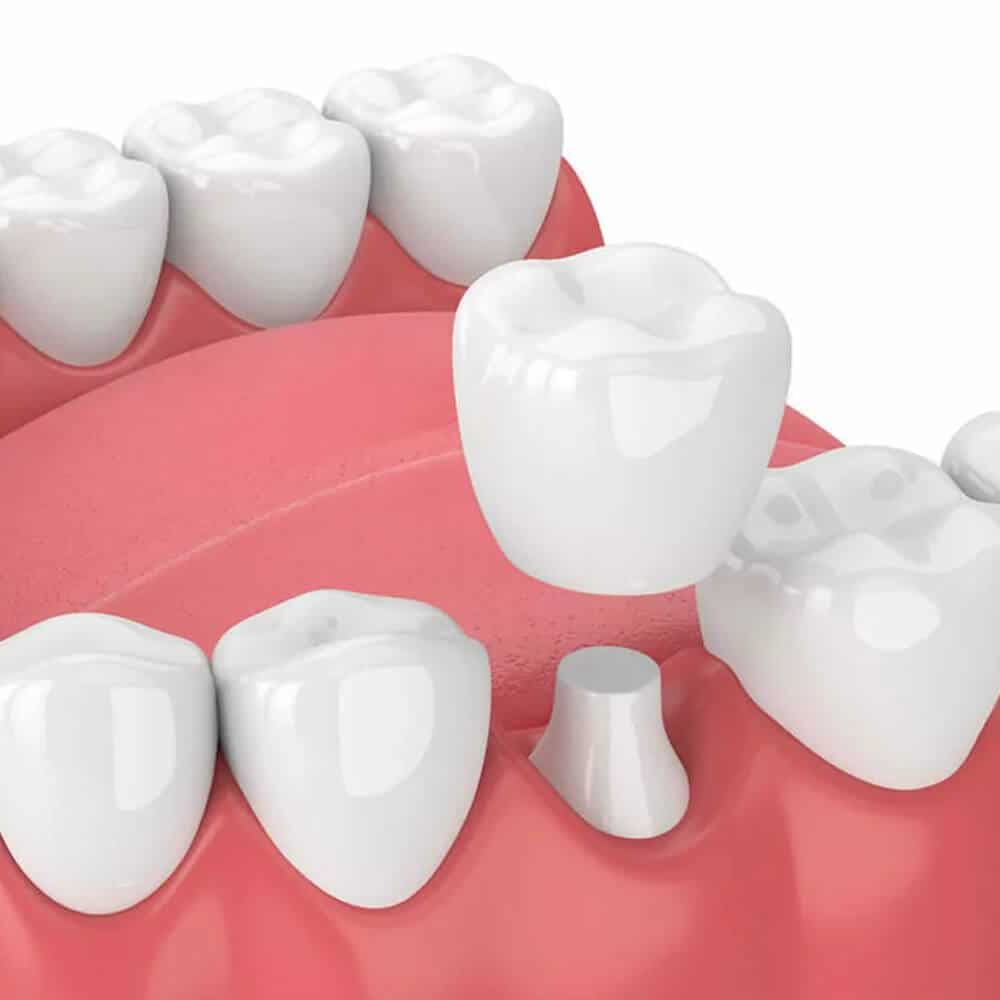 Dental implant illustration showing tooth replacement procedure with crown placement on gum model.
