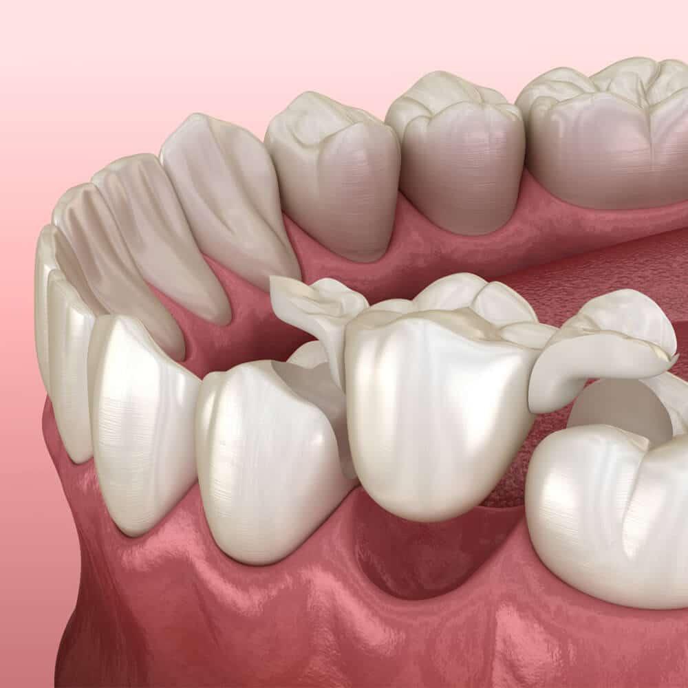 3D dental illustration showing tooth replacement options with implants and crowns on pink background.