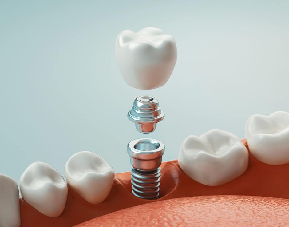 Dental implant cross-section diagram showing crown, abutment, and screw components with surrounding teeth model.
