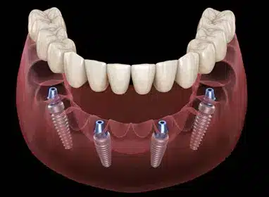 Dental implant model showing four titanium implants in lower jaw with prosthetic teeth restoration.