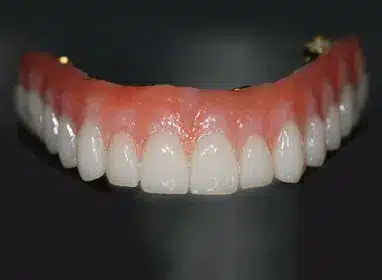 Dental prosthetic model displaying a full upper arch of white teeth with pink gum tissue against dark background.