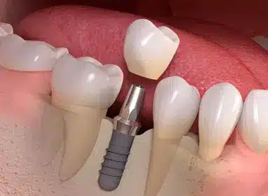 Dental implant model showing prosthetic tooth crown on implant fixture with adjacent teeth.