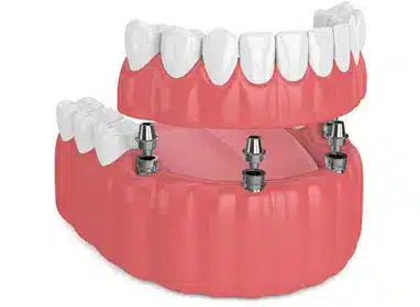 Dental implant model showing prosthetic teeth attached to implant fixtures in pink gum model.