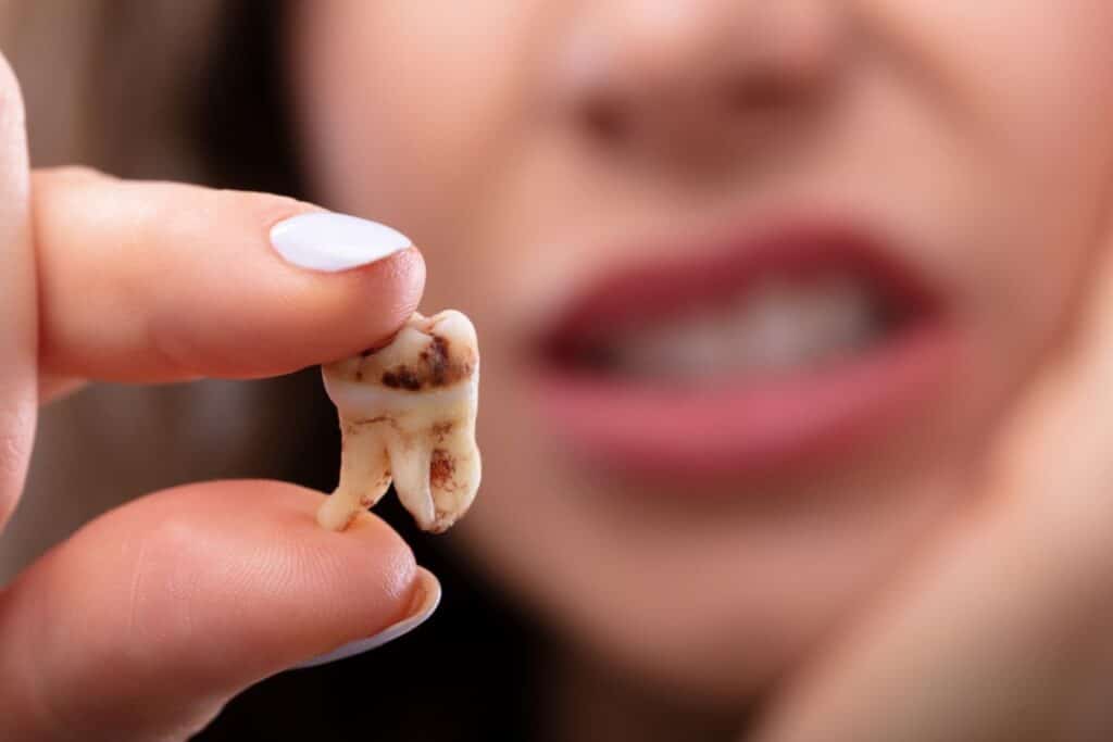 Decayed Tooth Falls Out