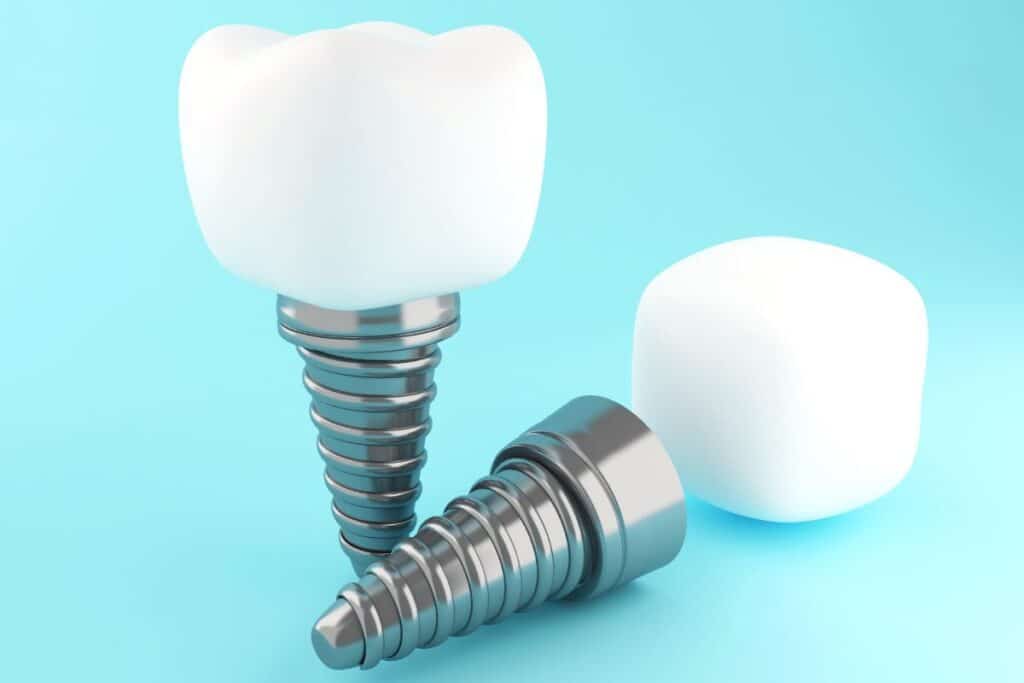 dental implants North Salt Lake