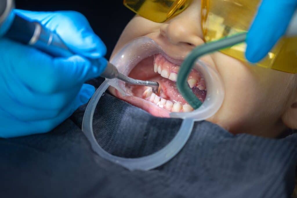 dental sealants in North Salt Lake