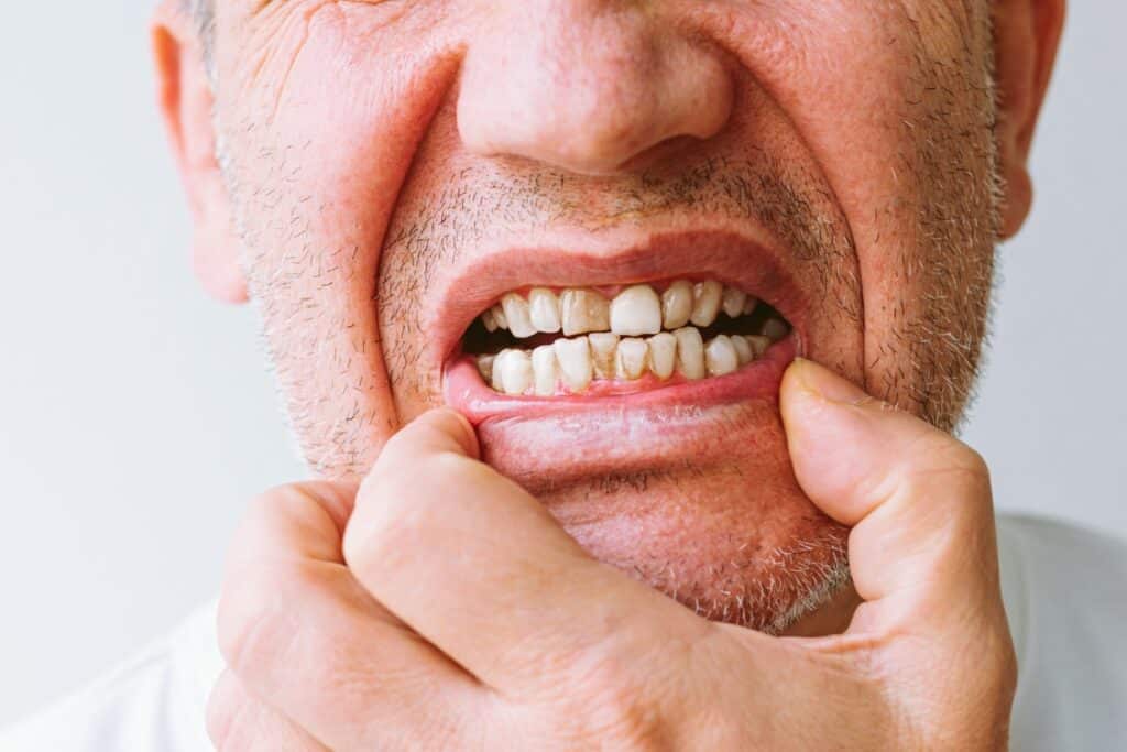 How to Remove Black Stains From Teeth