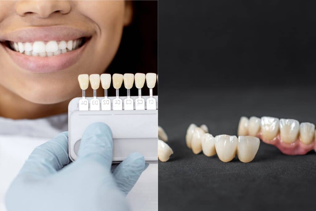How Do Veneers Compare to Dental Crowns for Smile Repair