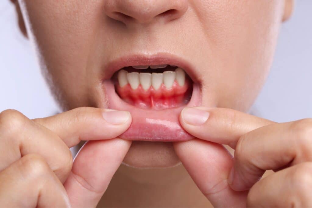 Can You Prevent An Abscessed Tooth Tips For Good Oral Health