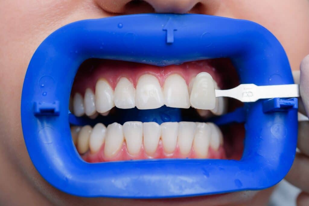 Common Mistakes That Can Damage Your Veneers
