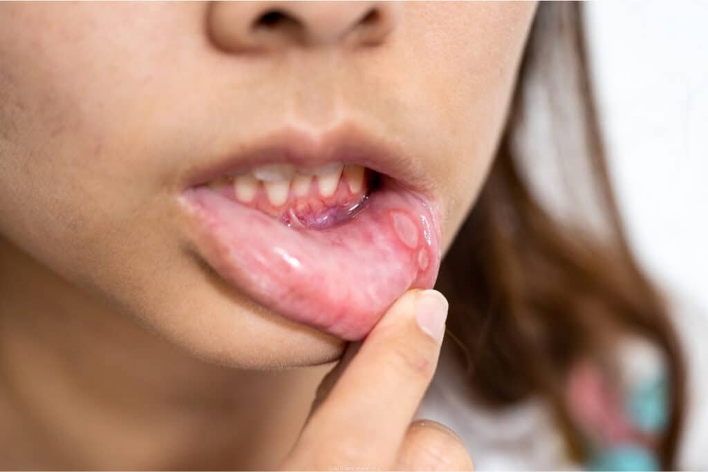 Banish Oral Ulcers: Proven Treatments for Mouth, Lip, and Dental Sores